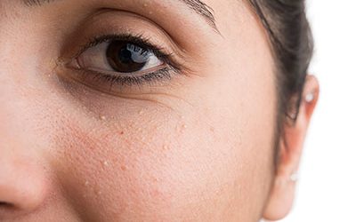Small bumps around the eyes