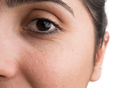 Small bumps around the eyes