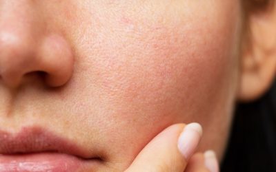 Enlarged Pores