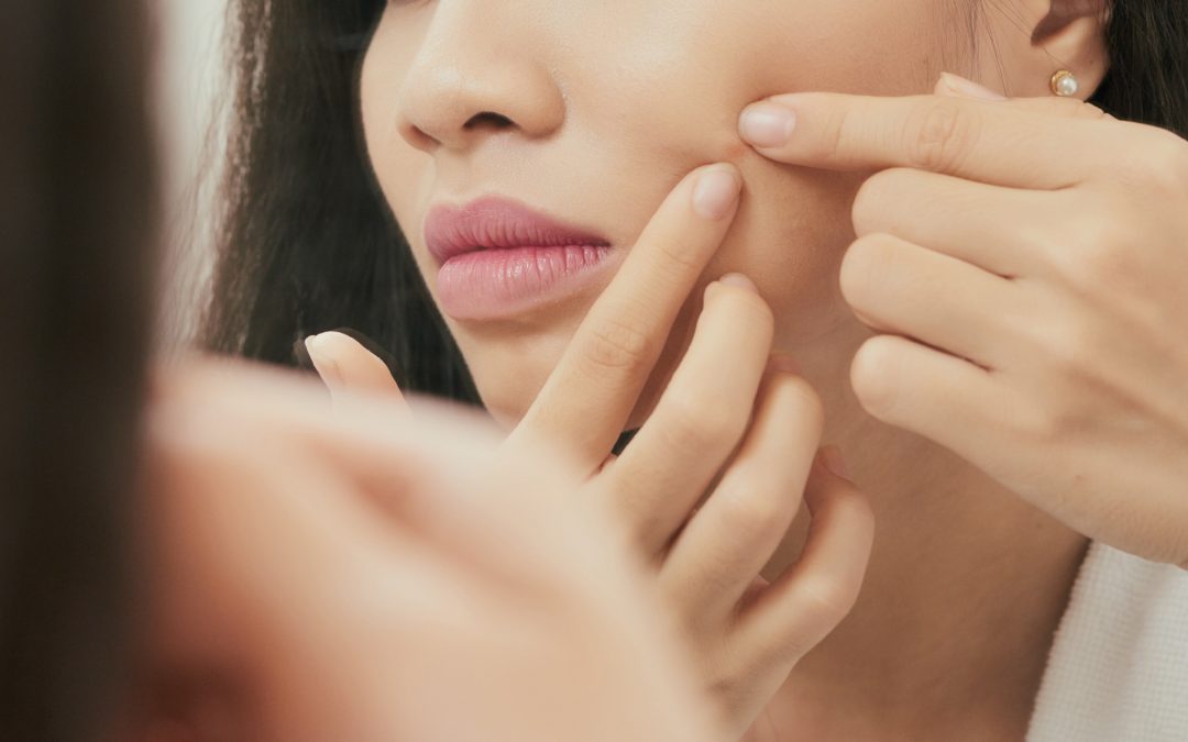 Should I pop my pimples?