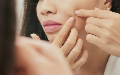 Should I pop my pimples?