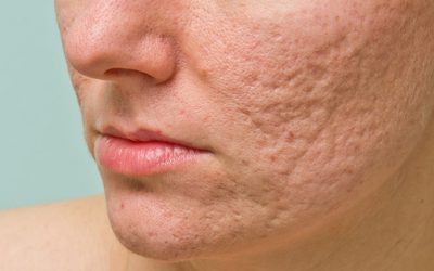 Acne Scars