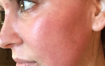 Q&A Series #5 Q: Doc, can you tell me more about the typical downtime after fractional CO2 laser?