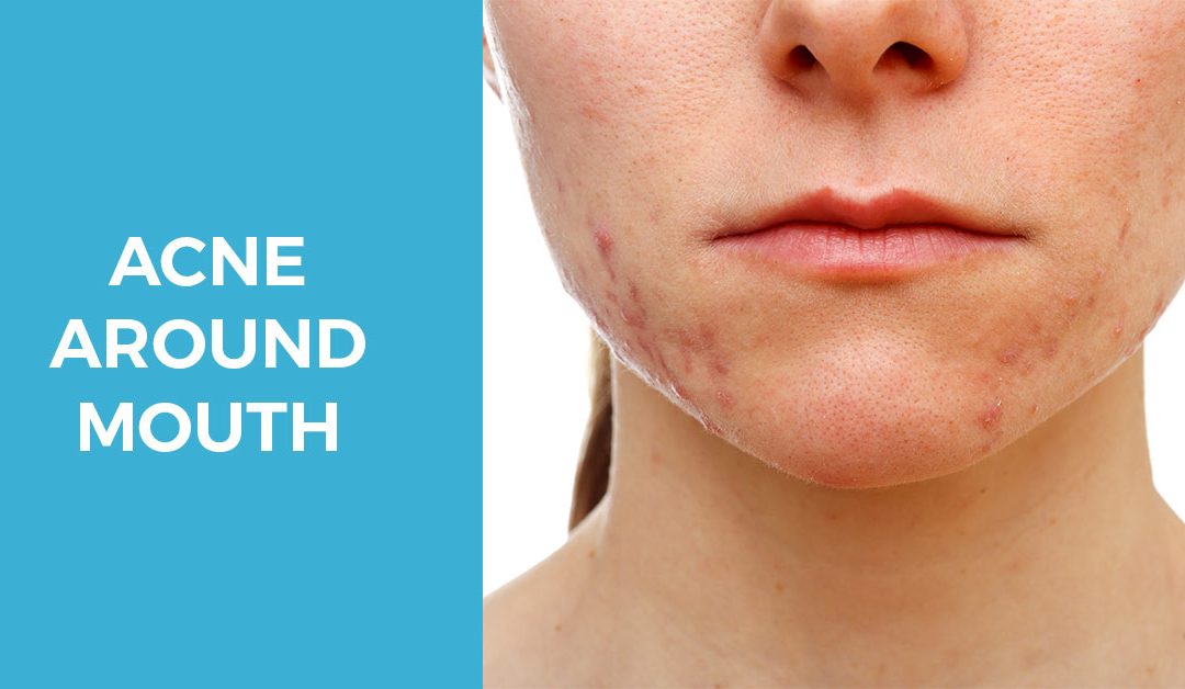 Q&A Series #1                          Q: Why my recurrent pimples are always around the mouth?