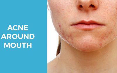 Q&A Series #1                          Q: Why my recurrent pimples are always around the mouth?
