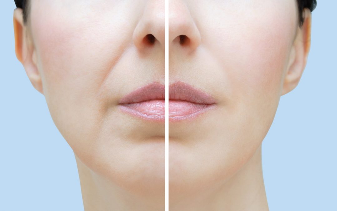 Q&A Series #3 Q: Doc, can I do subcision on my laughing lines?