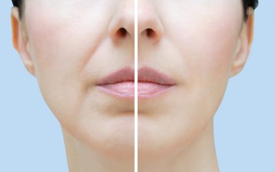 Q&A Series #3 Q: Doc, can I do subcision on my laughing lines?