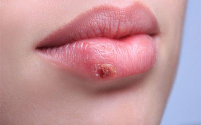 Q&A Series #2 Q: Ouch! My lips hurt!