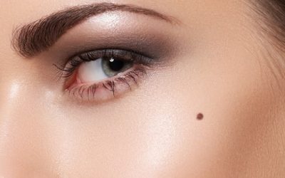 Q&A Series #4 Q: Can I remove my moles using laser?