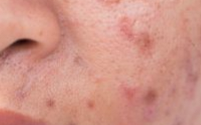 Q&A Series #14 Q: How to get rid of acne marks?