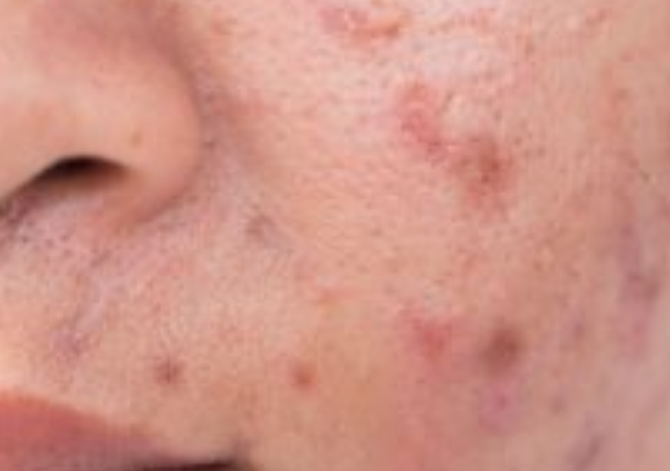 Q&A Series #14 Q: How to get rid of acne marks?