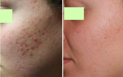 Q&A Series #13 Q: What are the options for facial scars?