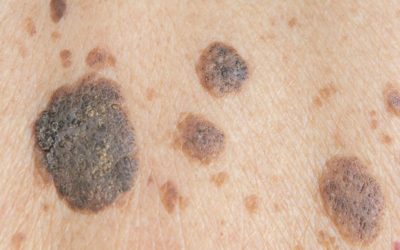 Q&A Series #8 Q: I get more and more of these on my face and body. What are they?
