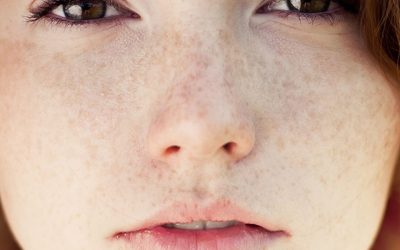 Q&A Series #19 Q: Do I still need to use anti-pigment treatment at home as I am already undergoing laser treatment?