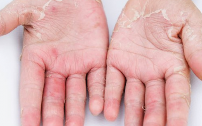 Q&A Series #21 Q: My hands have been itchy for the past 3 months and the skin on my palms thickened, cracked and scaly. I work as a florist.