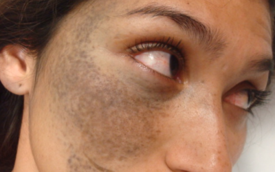 Q&A Series #24 Q: Doc, please help me for my birth mark!