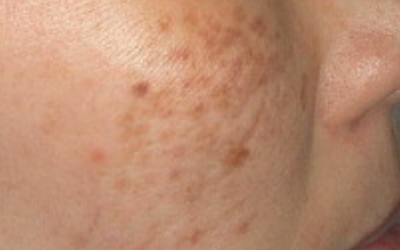 Q&A Series #25 Q: Doc, are these freckles?