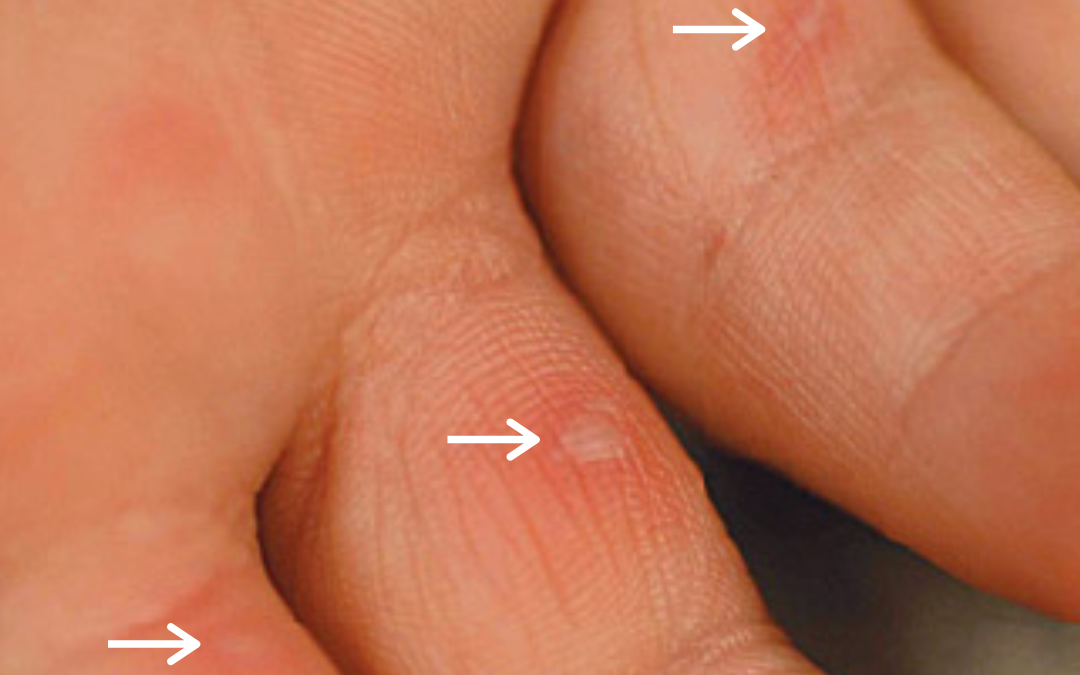 Q&A Series #26 Q: I have these persistent white, hard bumps on my fingers which are getting more by the day. What are they? How to get rid of them?