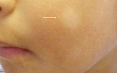 Q&A Series #27 Q: I notice there is a white patch on my child’s face. Can it be removed?