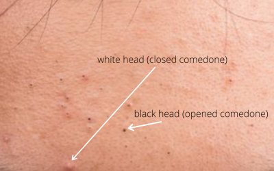 Q&A Series #28 Q: What are the differences between white heads and black heads?