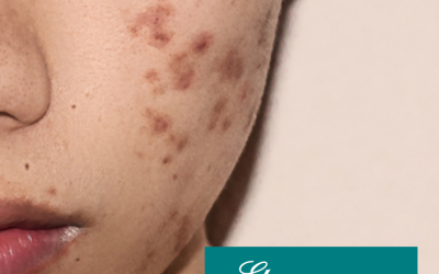 Q&A Series #30 Q: Are acne scars permanent?