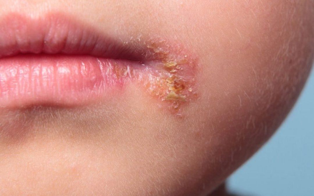 perioral-dermatitis-what-to-know-about-this-annoying-red-face-rash-self