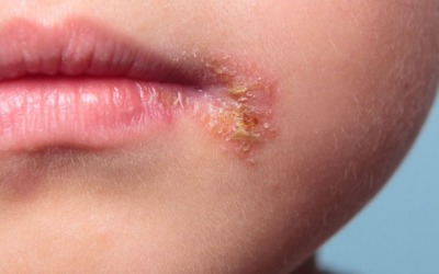 Q&A Series #31 Q: My child developed a few blisters at the corner of his mouth since 3 days ago. They were very itchy and after he started scratching them, the blisters burst and the wound become wet. He also developed some other patches on his neck, armpit and arms. He has no history of allergies.